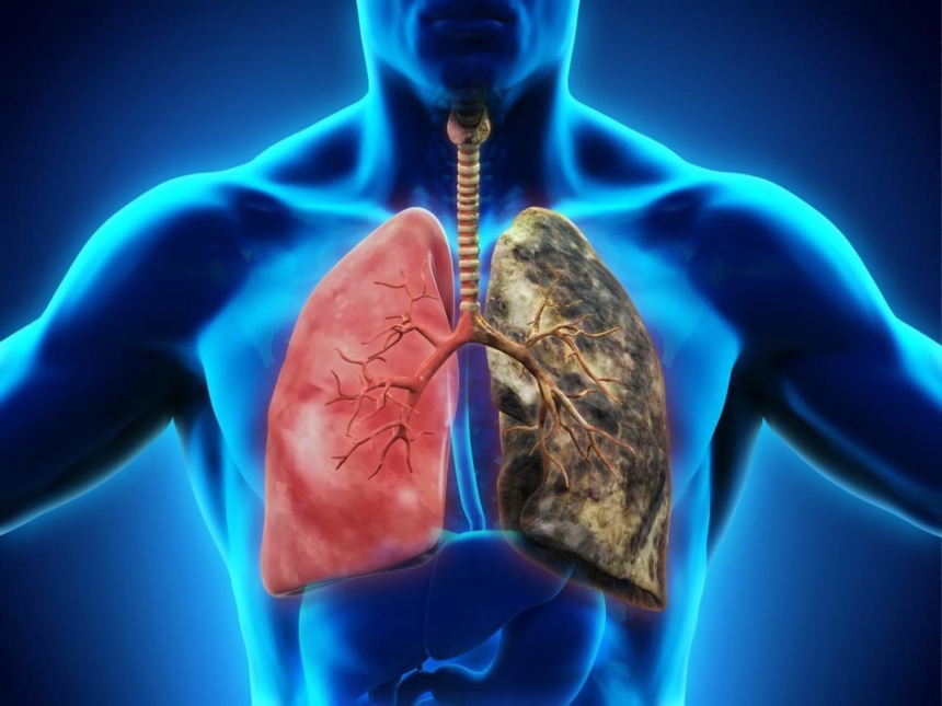 Thuốc điều trị viêm phổi cấp dùng loại nào 1